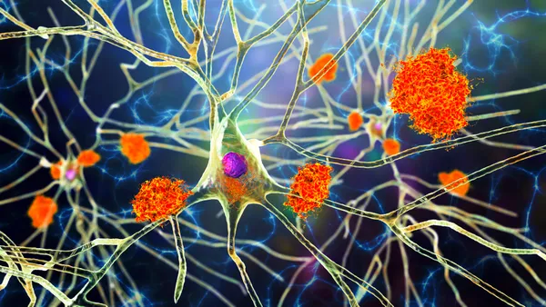 A 3D illustration showing amyloid plaques in brain tissue